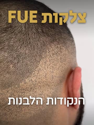 ריל: טשטוש צלקות FUE