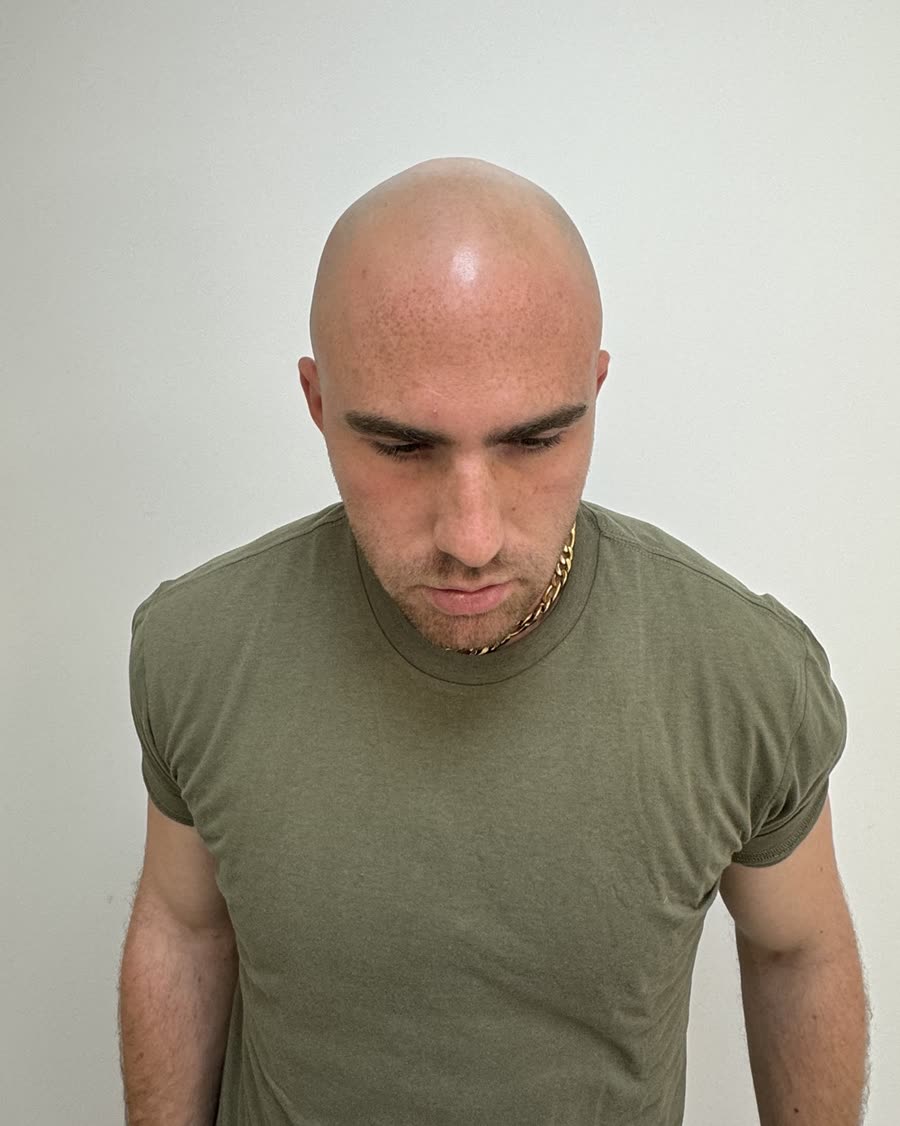 ישי לפני הטיפול